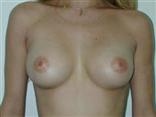 breast implants